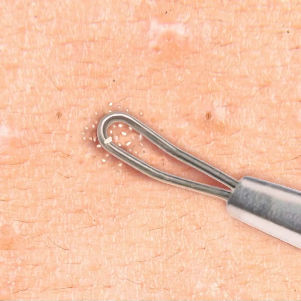 BEAUTÉ SOLINGEN Stainless Steel Blackhead Remover